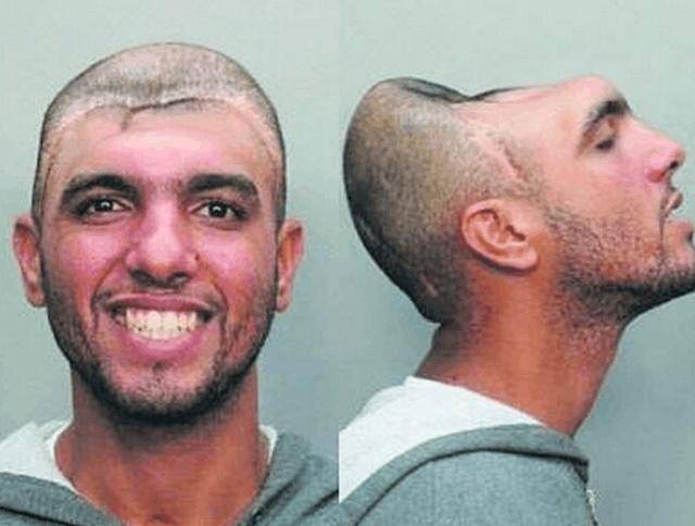 脑袋只剩半个还活着,男子成美国名人