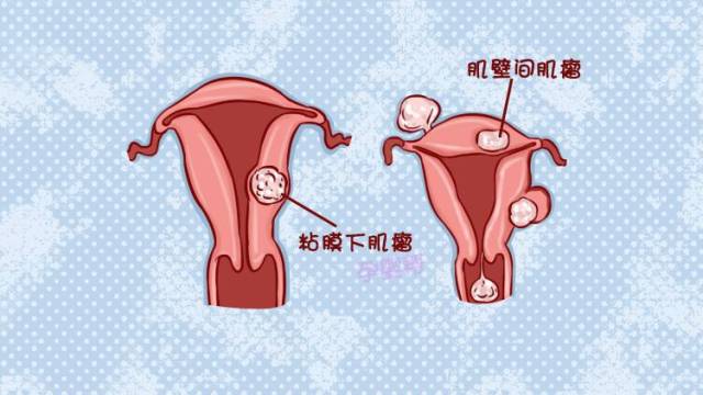 肌壁间子宫肌瘤位置图图片