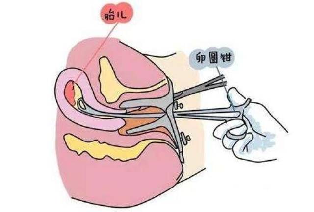 人流清宫手术过程图片图片