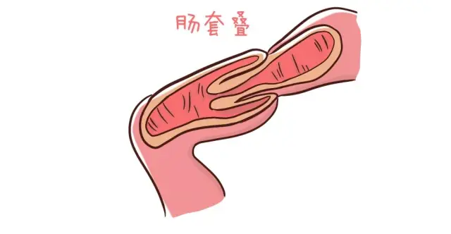 肠套叠症状图片