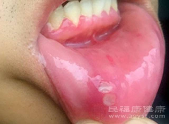 患者主要会出现反复性的口腔溃疡,以及阴部溃疡,皮疹,下肢结节红斑