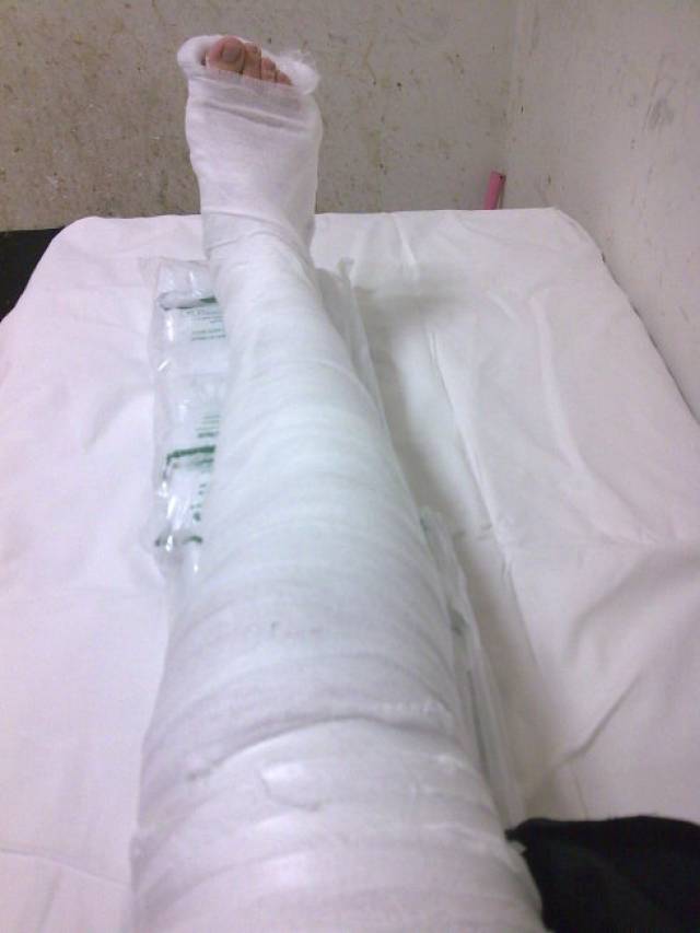 大腿骨折住院照片图片