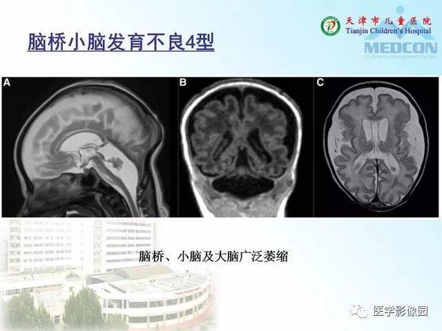 先天性小脑畸形的影像学表现