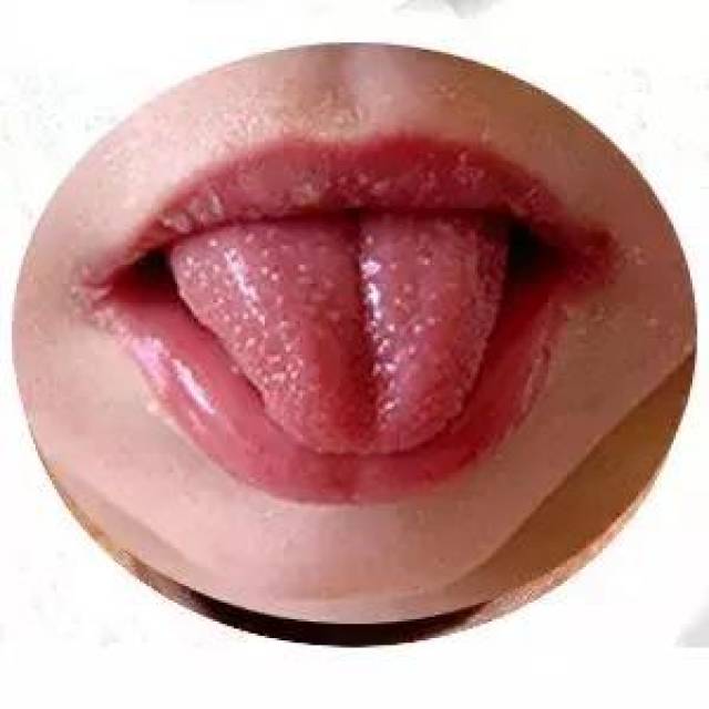舌头最怕出现这10种变化,尤其是第1种,可能预示舌癌!