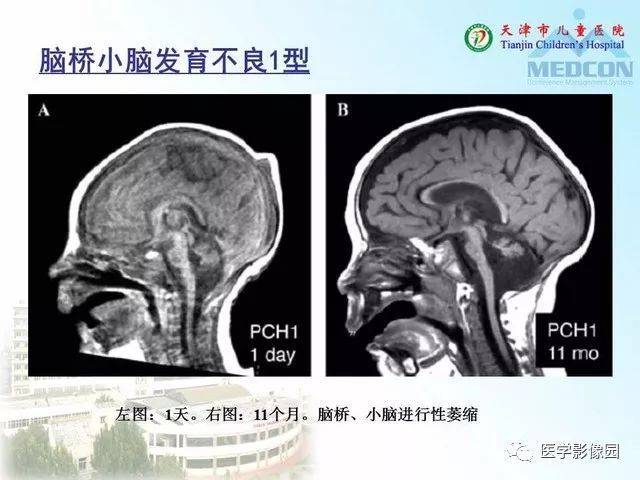 先天性小脑畸形的影像学表现