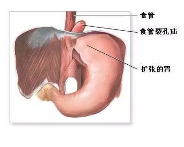 食管裂孔疝a环b环位置图片