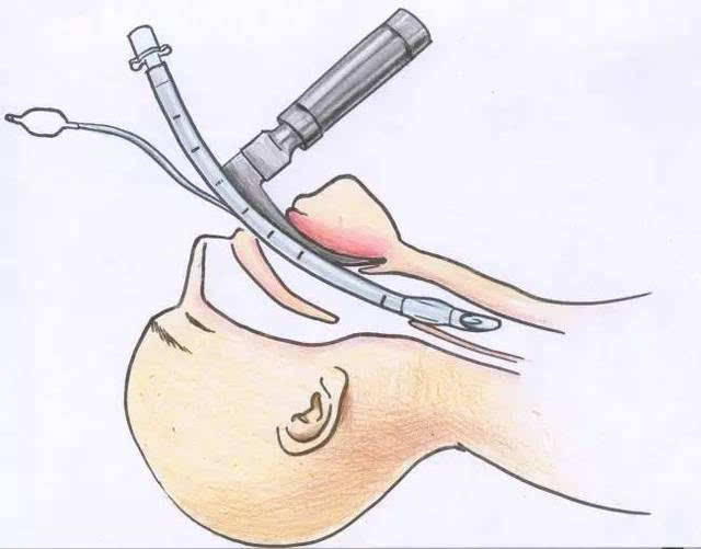 气管插管危险吗气管插管的病人还能活吗