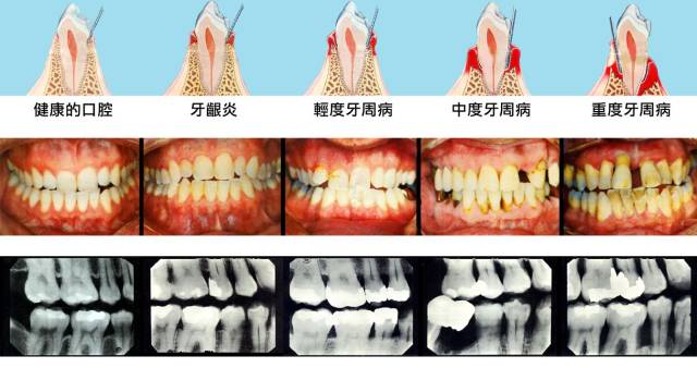 為什麼牙疼?原因在這裡