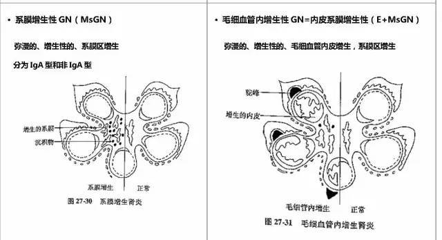 超實用筆記:腎小球疾病臨床與病理