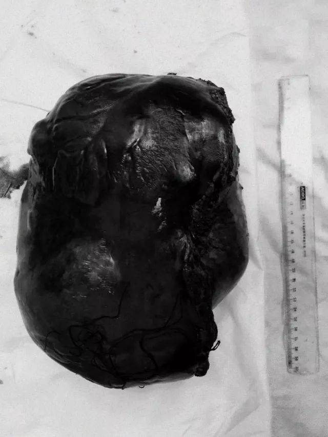 新闻快递医院普外三科成功切除巨大肝癌