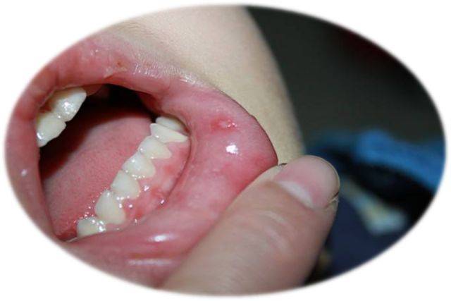 主要表现为口腔粘膜可见小疱疹或溃疡,手,足,臀部可见疱疹,同时有发热