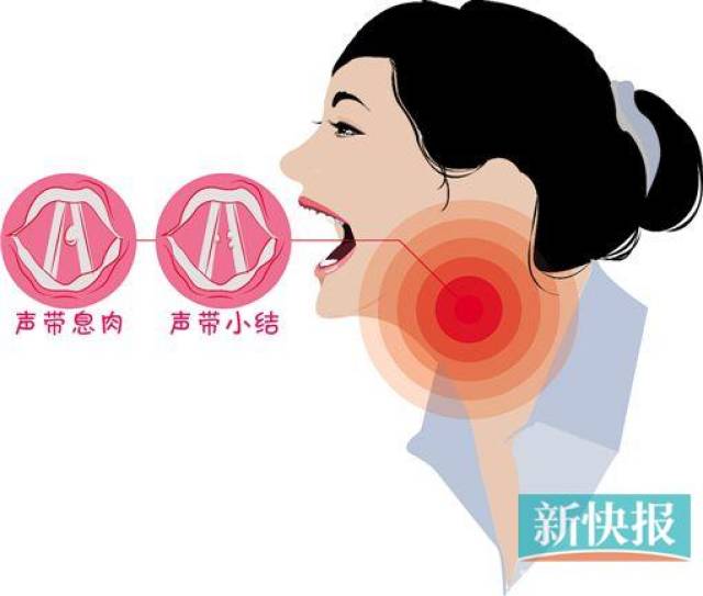 除了我们熟知的喉炎,声带小结,声带息肉外,"娘娘腔","男生女调","娃娃
