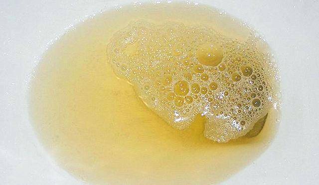 医生直言:牢记"两低"原则,尿蛋白高不了,可以避免尿毒症