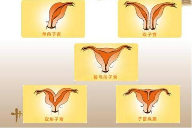 子宫畸形图片分类图片