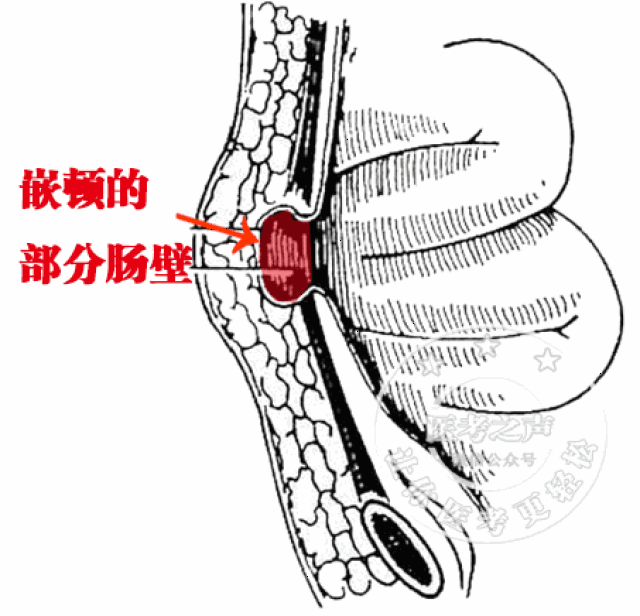 胸腹膜裂孔疝图片