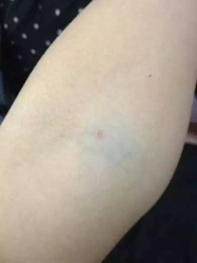 瘀青了怎么办怎么样才能快速消瘀