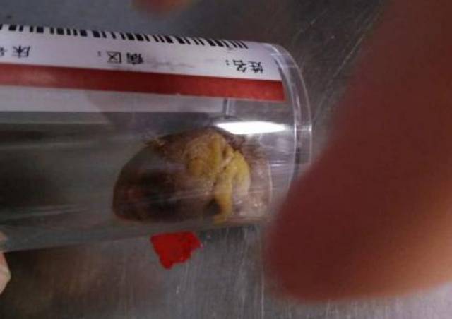 经过医生的仔细检查,孩子吐出的东西正是畸胎瘤.