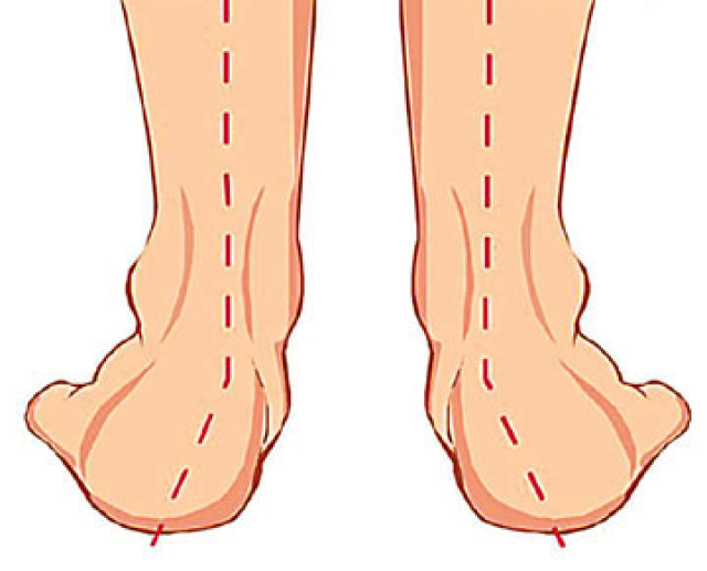 足外翻的自我矫正