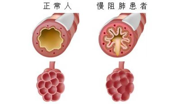 慢阻肺的康復利器縮唇和腹式呼吸鍛鍊