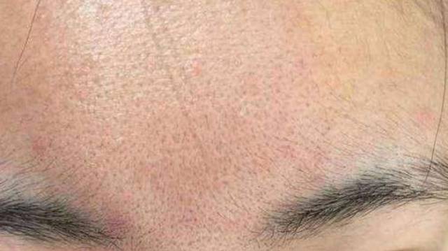 >> 缺水型毛孔粗大   --------- 解决方案: 因为缺水造成的