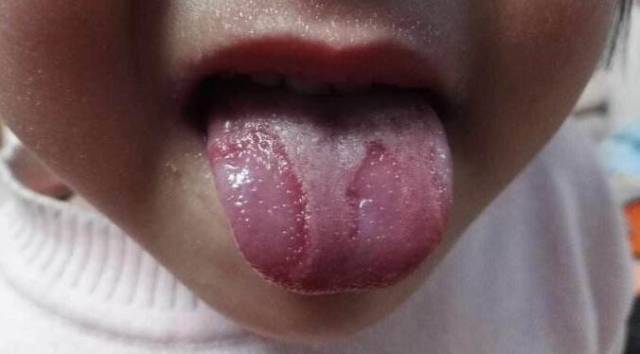 宝宝的舌头疾病地图舌常期化,了解能化解不少麻烦