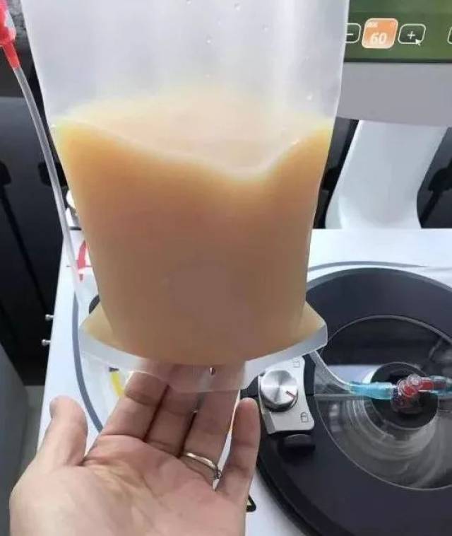 digipla80 血浆置换前先建立动静脉通道,将动脉端血液引入血浆分离器