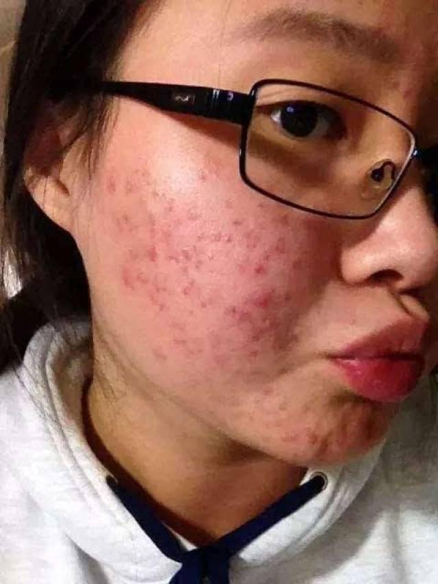 草然堂:你这种性格,会长痘的