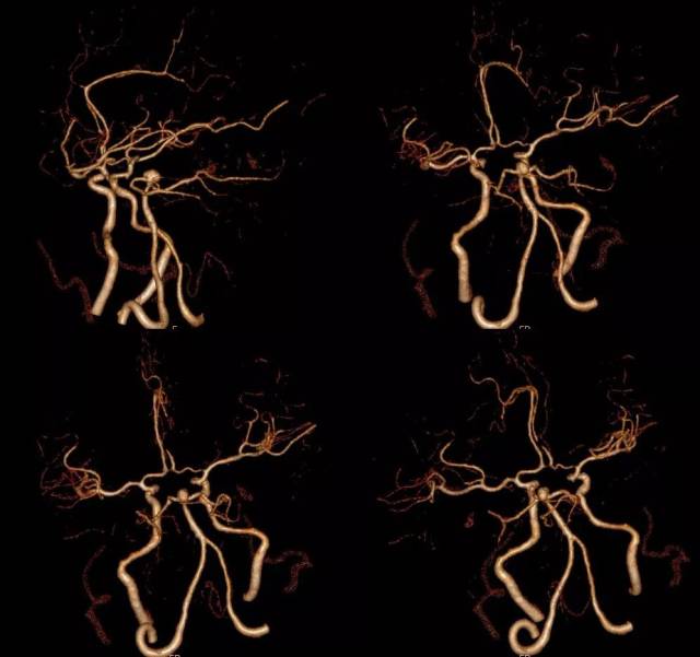 图3-2. 患者入院后头颅cta提示基底动脉顶端动脉瘤,大小约0.5×0.8cm.