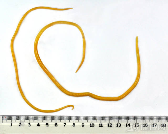 4,蛔虫病 如果经常接触污染性的食物,比如霉变食品,那么肠胃可能会