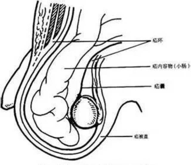 這時,家長們就會發現鼓包,有時在腹股溝,有時在陰囊.