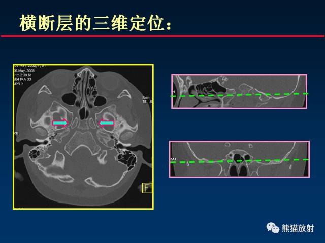 【柳澄讲坛】颅底重要ct解剖及其临床意义