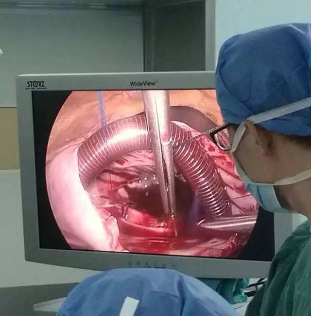开胸手术电锯图片