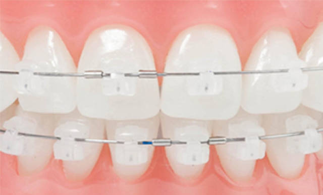 牙齿矫正不必拘泥于金属牙套!多种矫正方式任