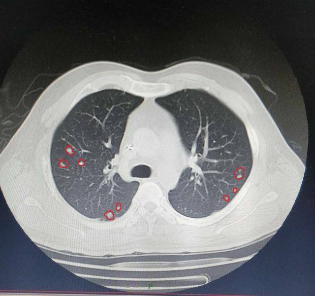 因一次腹胀,却查出了肿瘤,都是乙肝惹得祸(内附ct,化验单)