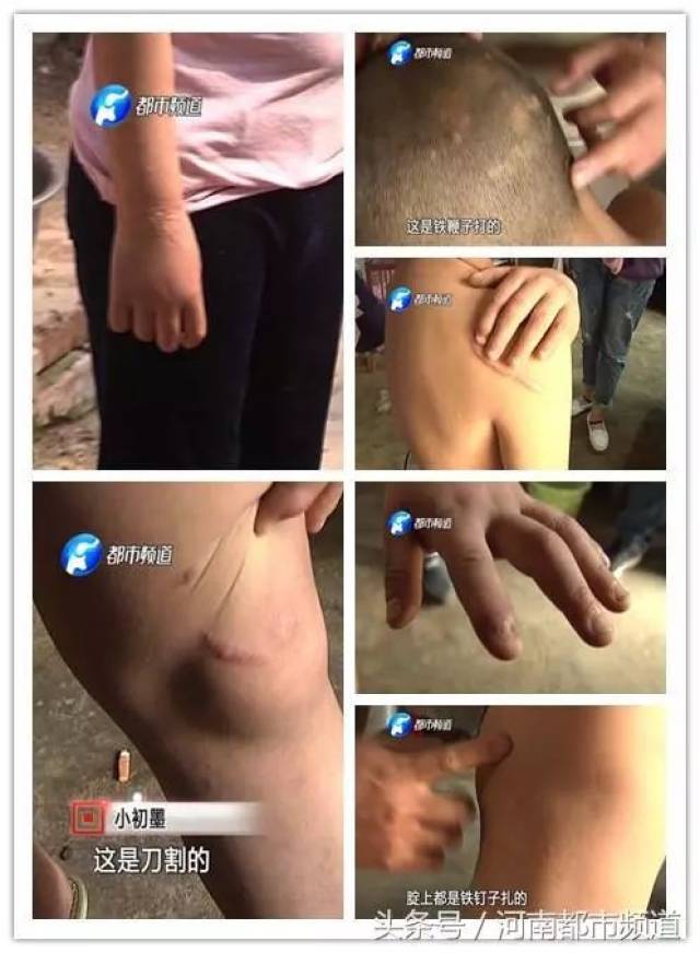 濮阳七岁男孩山西学杂技,却遭虐待遍体鳞伤.
