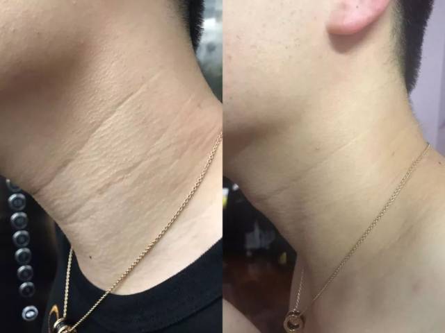 " "颈部凸起的脂肪粒在