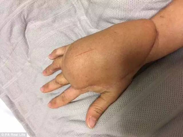 澳洲妈妈不小心被割到手,一个小小的伤口,最后她却差点截肢,差点丢掉