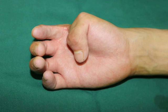 迟来20年的手术