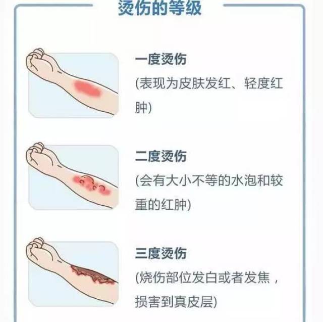 烫伤后的紧急处理正不正确,有时候决定了孩子受伤的程度