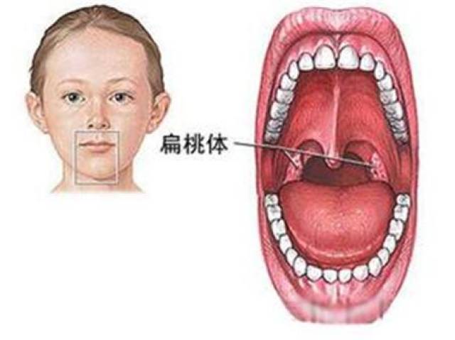 扁桃体发炎是怎么回事扁桃体属于淋巴组织,属于人体呼吸道的免疫器官