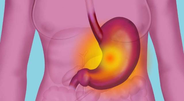 胃溃疡位置图片图片