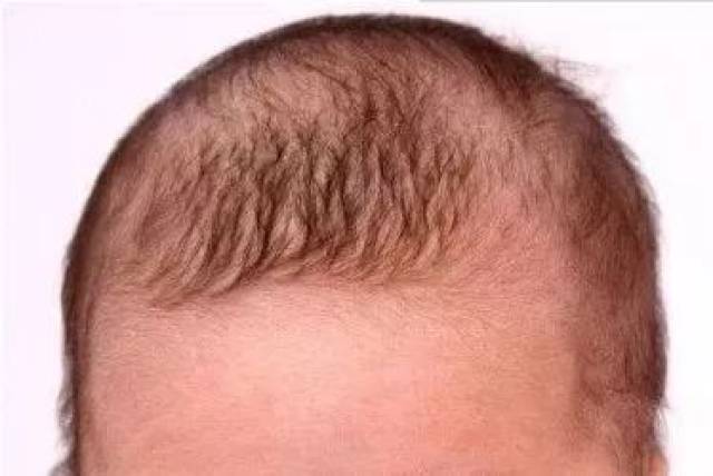 婴儿缺钙头发症状图片图片