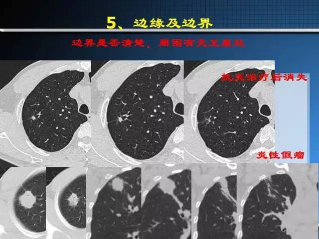 肺部结节的11种鉴别诊断方法
