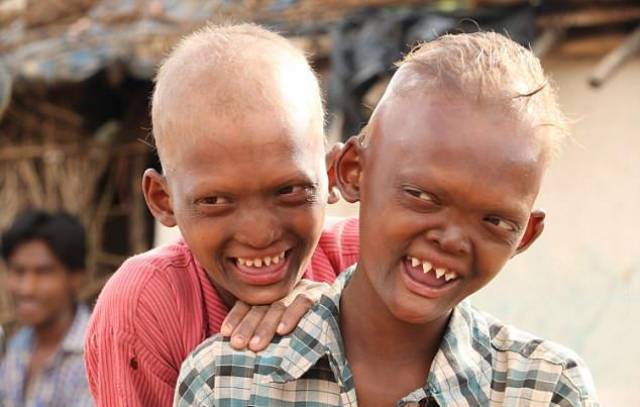 印度一对兄弟患罕见怪病,怪异的长相被人称为"外星人"