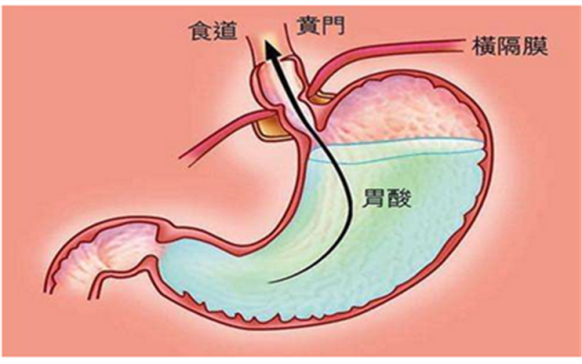 胃酸怎么缓解最快方法图片