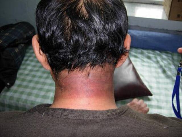 背上长了这种疮,一不小心就会痛死,到底是什么?