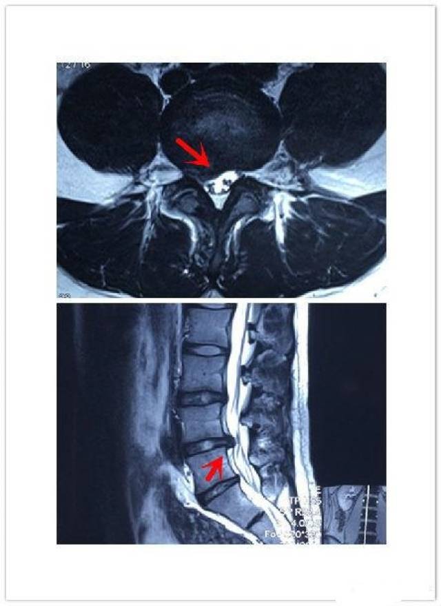 腰椎l4/5椎间盘位置图片