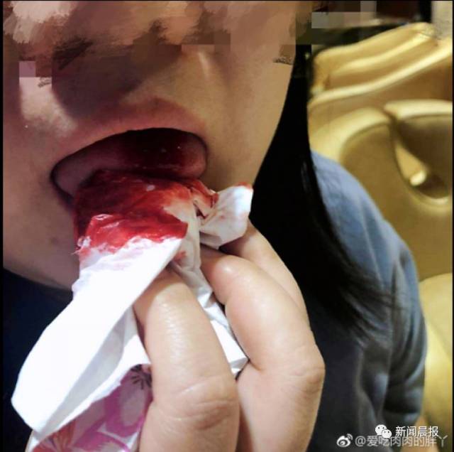 吃个冰淇淋竟满嘴血!哈根达斯:赔偿200元现金券
