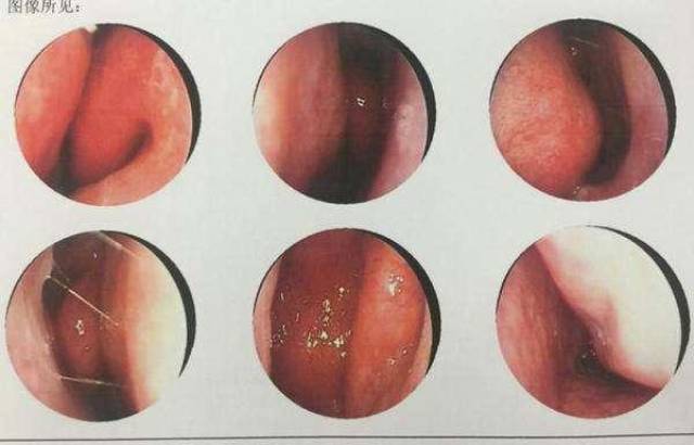 由其他鼻腔疾病引发的鼻咽炎 过敏性鼻炎, 血管舒缩性鼻炎,萎缩性鼻炎