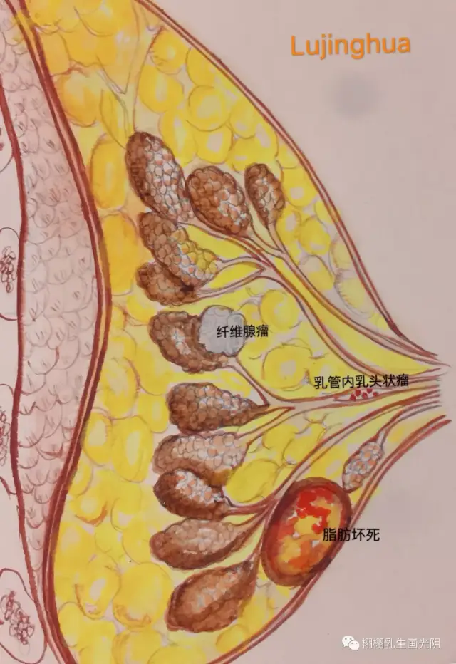 乳腺导管扩张: 又叫粉刺样乳腺炎,有的是因为乳头内陷,藏污纳垢引起的